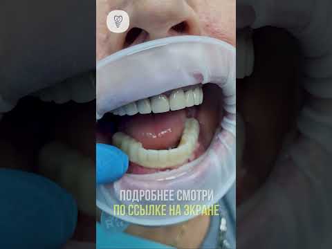 «Выберите оптимальный план имплантации 36, 37, 46, 47 в хирургической стоматологии»