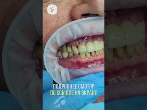 «Выберите оптимальный план имплантации 36, 37, 46, 47 в хирургической стоматологии»